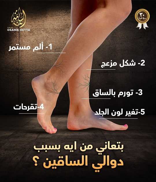 دوالي الساقين