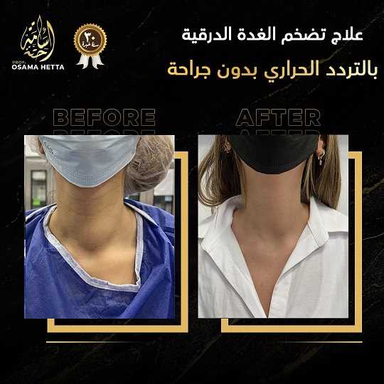 الغدة الدرقية