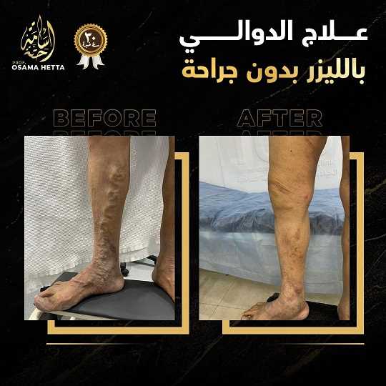 دوالي الساقين