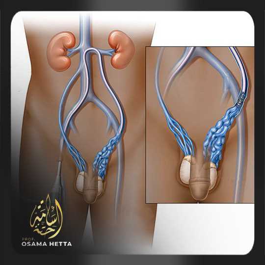 دوالي الخصية