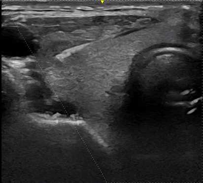 biopsy