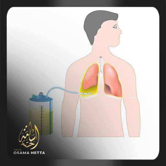 بزل التجمعات