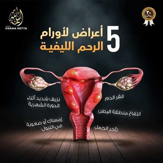 علاج الأورام الليفية