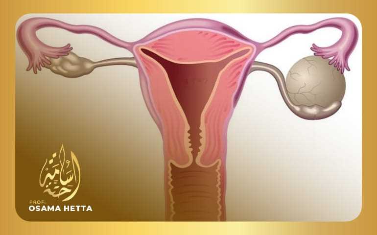 علاج دوالي الحوض بالأشعة التداخلية