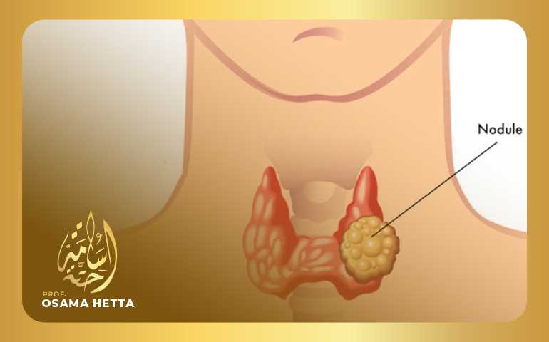 علاج تضخم الغدة الدرقية